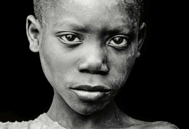 A child bears the scars of genocide in Rwanda.