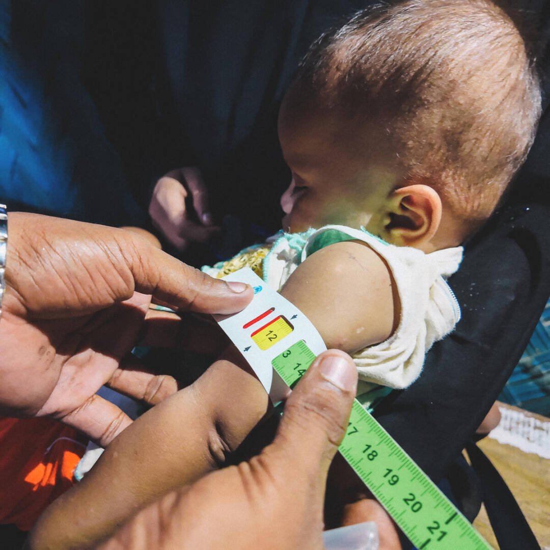 Health worker measures a young child’s arm with MUAC tape while the child is held by her mother. The tape shows yellow, indicating moderate acute malnutrition.