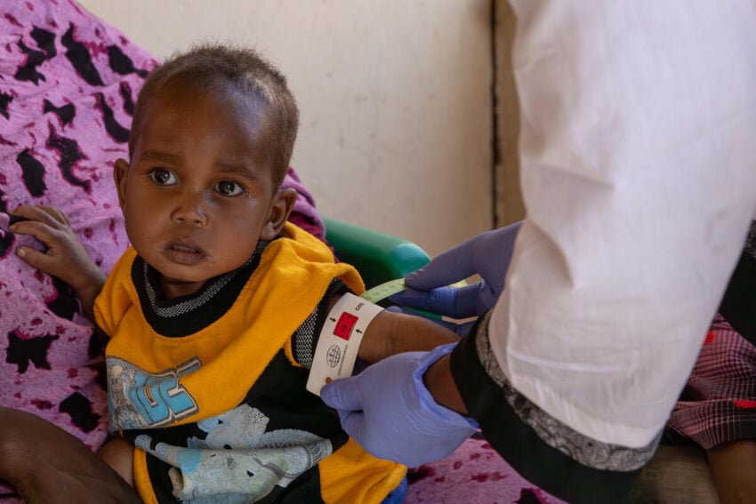 A healthcare worker measures a young child’s arm is measured with a band that uses colors to indicate a child’s health. The band shows red, which indicates severe malnutrition.