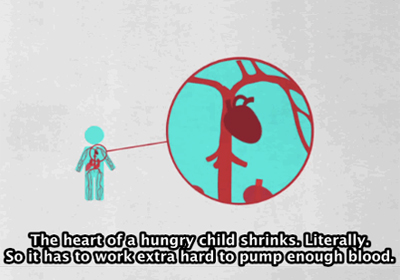 Upworthy video: Find out the fastest and saddest way to shrink a child's heart ... literally